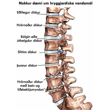 Mismunandi ástand hryggjarliða.